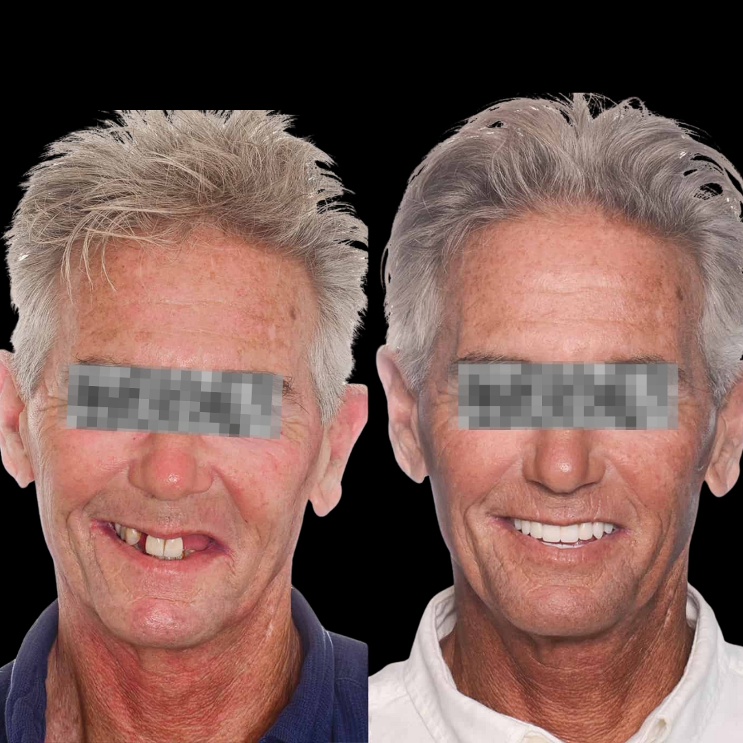 Caso 4 — prima e dopo