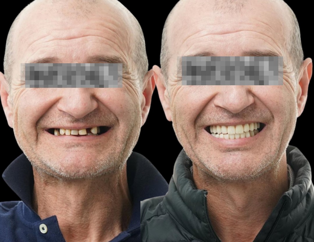 Caso 5 — prima e dopo